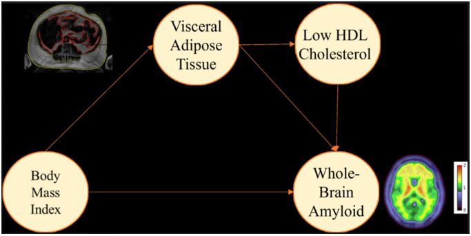 Schematic result of our study showing how BMI is mediated or explained by higher visceral/hidden fat and not subcutaneous fat in terms of higher amyloid signal in the brain on PET and lower HDL or less good cholesterol makes this issue worse. 
